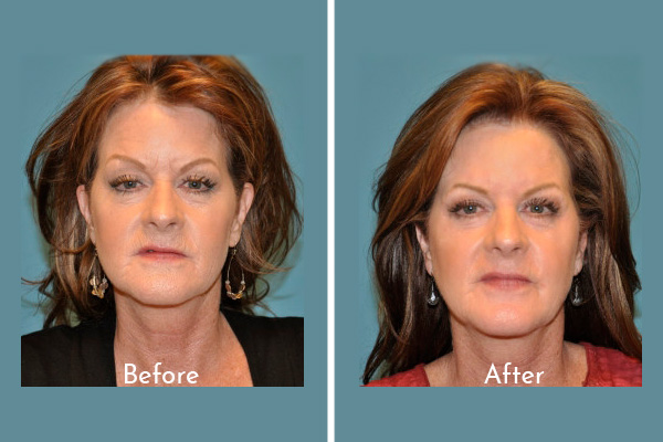 Portrais of woman before and after skin rejuvination