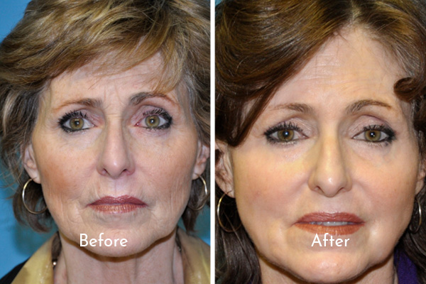 Portraits of woman before and after skin resurfacing